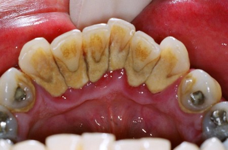 Mảng bám cao răng bên trong hàm răng