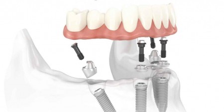 Kỹ thuật trồng răng Implant là gì 