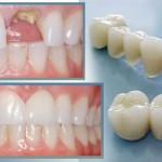 Những điều bạn cần tìm hiểu trước khi bọc răng sứ
