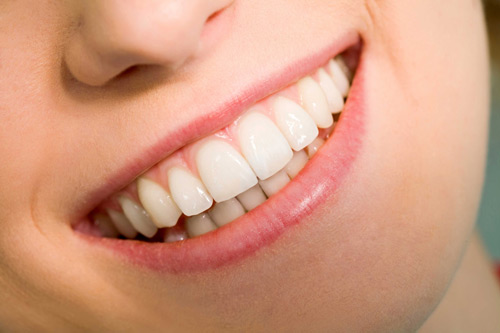 Niềng răng hay bọc răng sứ khi răng bị hô