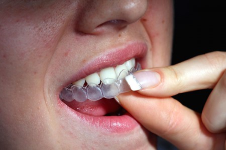 Kỹ thuật tẩy trắng răng