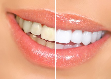 Tẩy trắng răng tại nhà có tốt không?