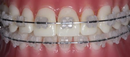 Những phương pháp niềng răng thẩm mỹ hiện nay