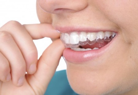 Những ưu điểm của niềng răng invisalign