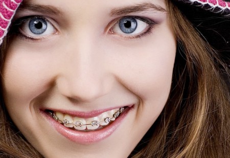 Ưu điểm của phương pháp niềng răng không nhổ răng