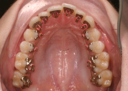 Những điều bạn cần biết về niềng răng