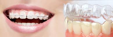 Niềng răng lệch lạc