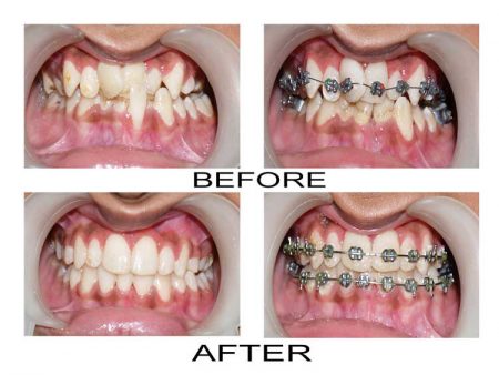 Niềng răng lệch lạc