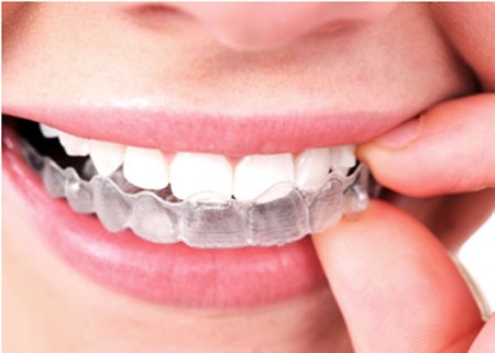 Tẩy trắng răng tại nhà có tốt không?