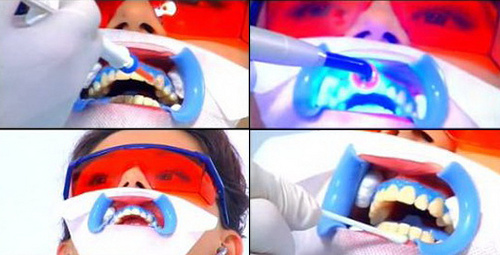 Kỹ thuật tẩy trắng răng