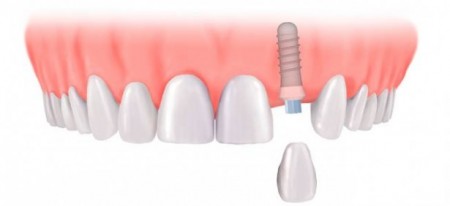 Giải pháp trồng răng Implant khi bị mất một răng
