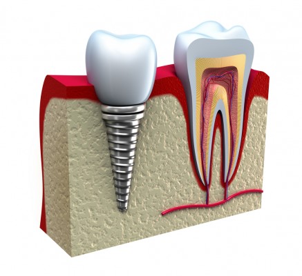 Giải pháp trồng răng Implant khi mất răng toàn hàm