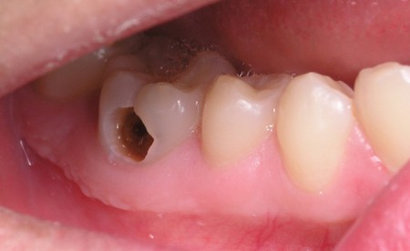 Có nên nhổ răng bị sâu không?
