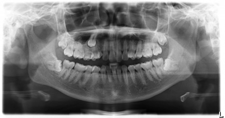Răng khôn và những biến chứng thường gặp