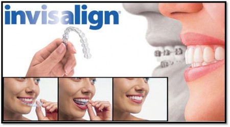 Quy trình của niềng răng bằng khay Invisalign