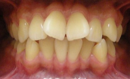Khắc phục hàm răng không thẳng hàng 