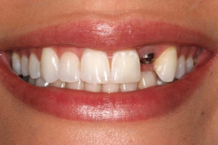 Sự tiên tiến trong lĩnh vực trồng răng giả 