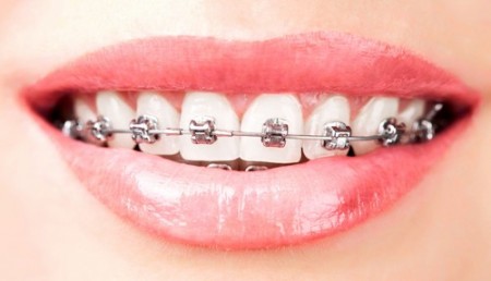 Tại sao chọn niềng răng để thay đổi hàm răng ?