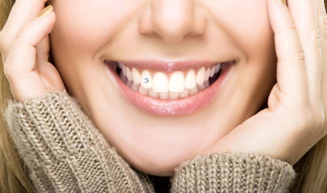răng sứ Cercon giá bao nhiêu