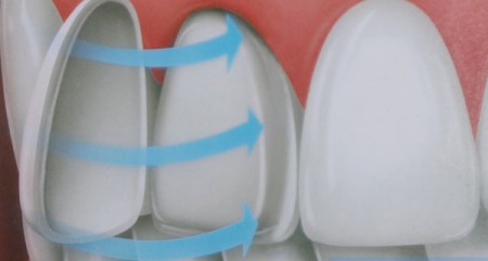 Ưu điểm của bọc răng toàn sứ với công nghệ CT 5