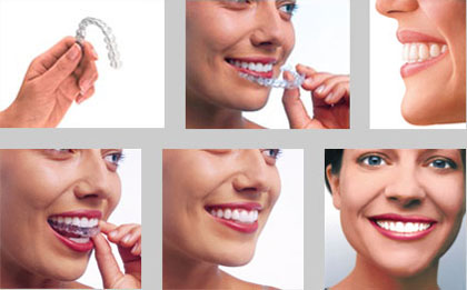 Khí cụ niềng răng bằng nhựa có hiệu quả không?