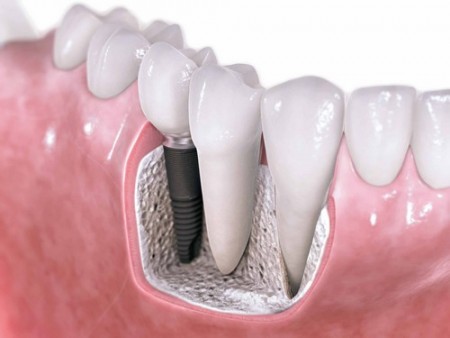 Phương pháp làm răng sứ không mài cùi răng 