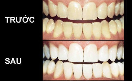 Làm trắng răng khi nhiễm Tetracycline