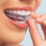 Niềng răng bằng nhựa