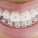 Niềng răng với mắc cài sứ