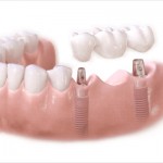 Phục hình răng bị mất với phương pháp trồng răng giả