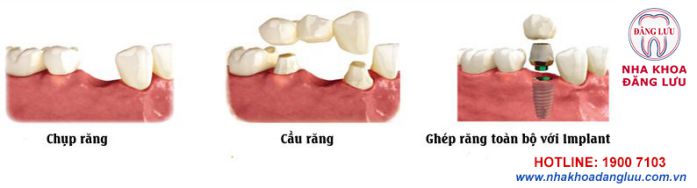 Phục hình răng bị mất với phương pháp trồng răng giả