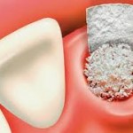 Phương pháp trồng răng cần ghép xương nhân tạo