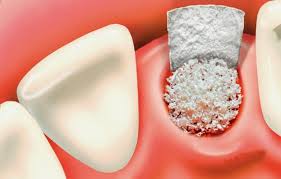 Phương pháp trồng răng cần ghép xương nhân tạo