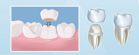 Trồng răng cố định tốt tại nha khoa