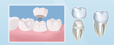 Trồng răng cố định tốt tại nha khoa