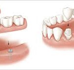 Trồng răng cố định tốt nhất