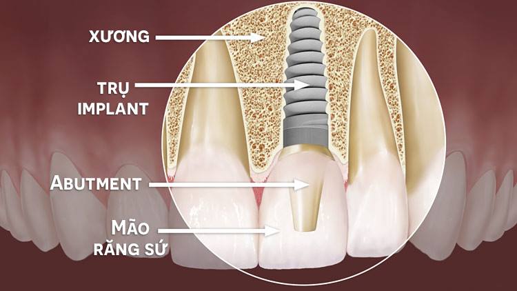 Trồng răng cố định tốt tại nha khoa