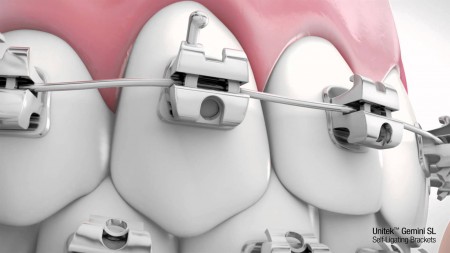 Giải pháp can thiệp khi răng bị móm