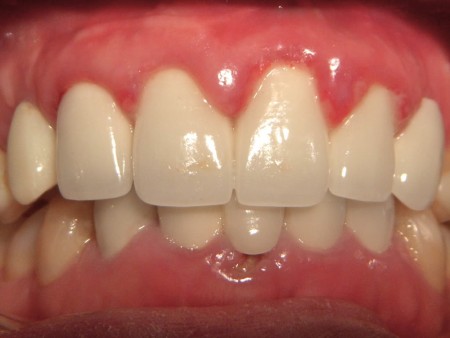 Tác hại của viêm nướu răng