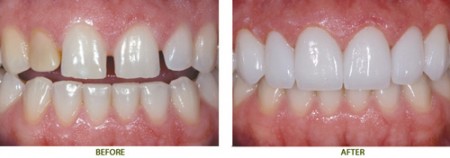Lựa chọn phương pháp giúp răng đẹp hoàn hảo 
