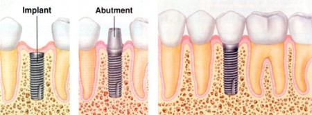 Trồng răng Implant giá cao không 