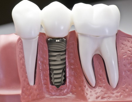 Chi phí cấy ghép răng Implant giá bao nhiêu tiền