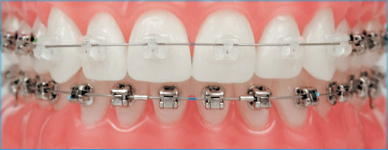 Điều trị niềng răng tại nha khoa