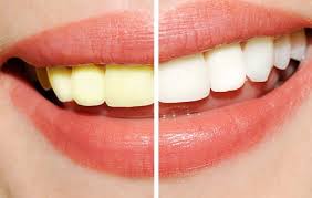 Tẩy trắng răng có tác động đến men răng