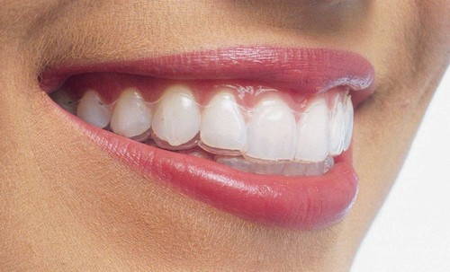 Invisalign phương pháp niềng răng thẩm mỹ