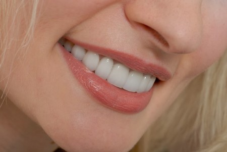 Chi phí bọc răng sứ Cercon