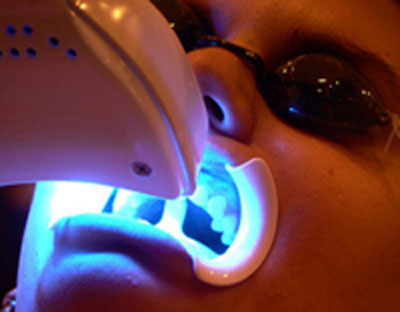 Tẩy trắng răng có tác động đến men răng