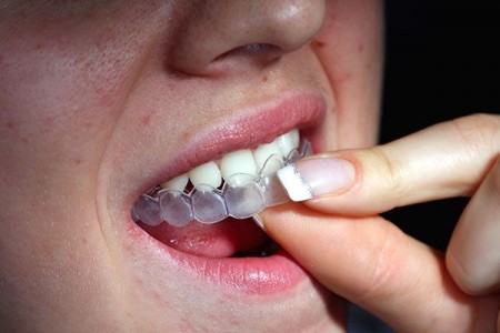Máng tẩy trắng răng là gì ?