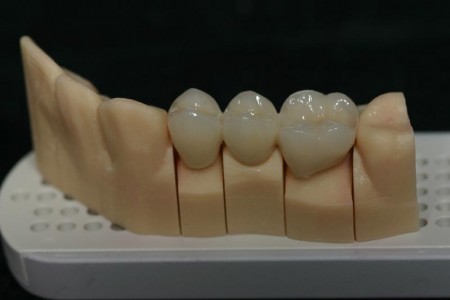 Răng sứ Zirconia có ưu điểm gì ?