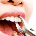 Làm gì khi răng vĩnh viễn bị lung lay?